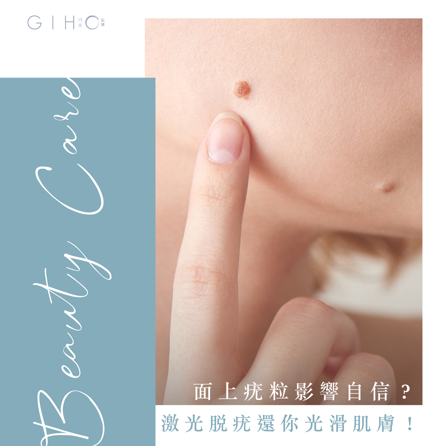 面上疣粒影響自信？激光脫疣還你光滑肌膚！