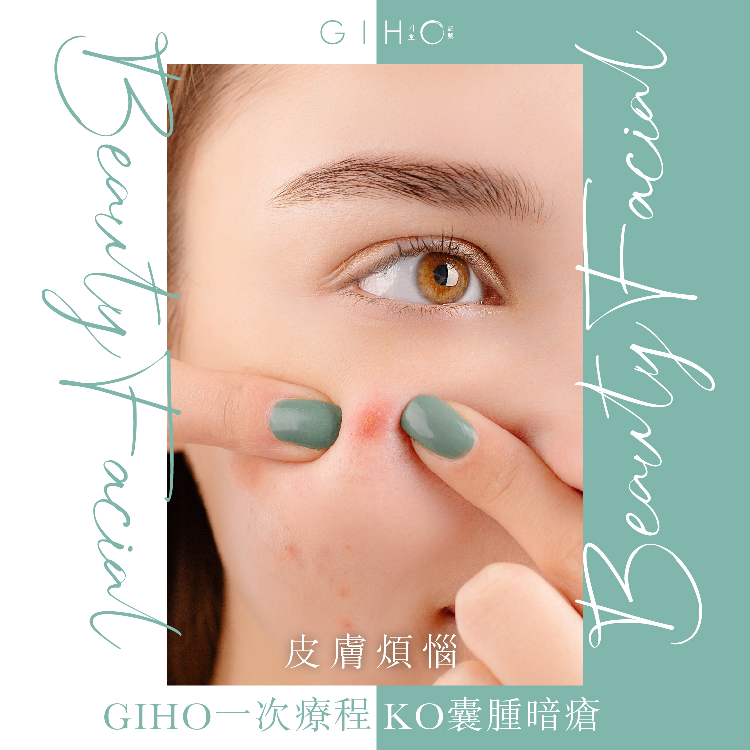 皮膚煩惱|GIHO一次療程KO囊腫暗瘡