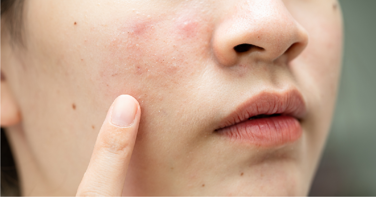 GIHO, 暗瘡療程, 膚色暗黃, 暗瘡, 痘印, 玫瑰痤瘡, 色斑, 毛孔粗大, 微絲血管, 泛紅過敏, 粉刺 , 黑頭, 毛孔粗大, 油脂分泌旺盛, 深層清潔, 殺菌消炎, 平衡水油, 淡化痘印, 九龍, 沙尖咀, 沙尖咀按摩, 沙尖咀美容, 九龍美容, 九龍按摩