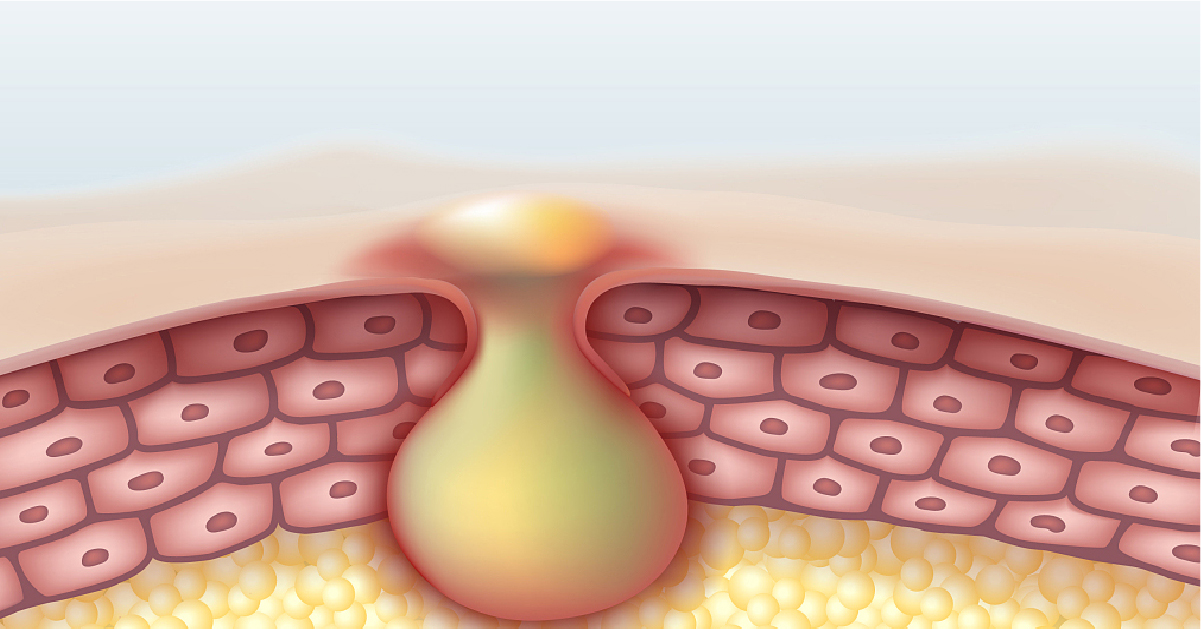 GIHO, 暗瘡療程, 膚色暗黃, 暗瘡, 痘印, 玫瑰痤瘡, 色斑, 毛孔粗大, 微絲血管, 泛紅過敏, 粉刺 , 黑頭, 毛孔粗大, 油脂分泌旺盛, 深層清潔, 殺菌消炎, 平衡水油, 淡化痘印, 九龍, 沙尖咀, 沙尖咀按摩, 沙尖咀美容, 九龍美容, 九龍按摩